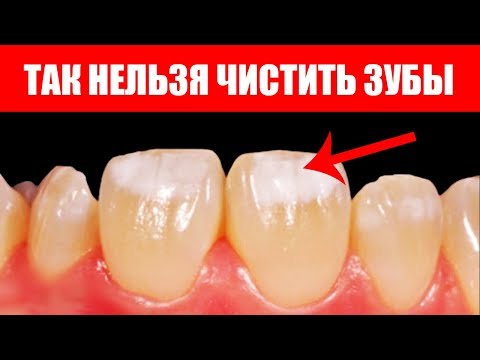 Как Отбелить Зубы В Домашних Условиях. Пищевая Сода