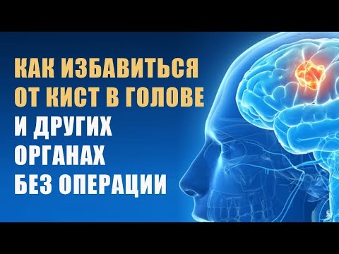 Киста. Как избавиться без операции народными способами